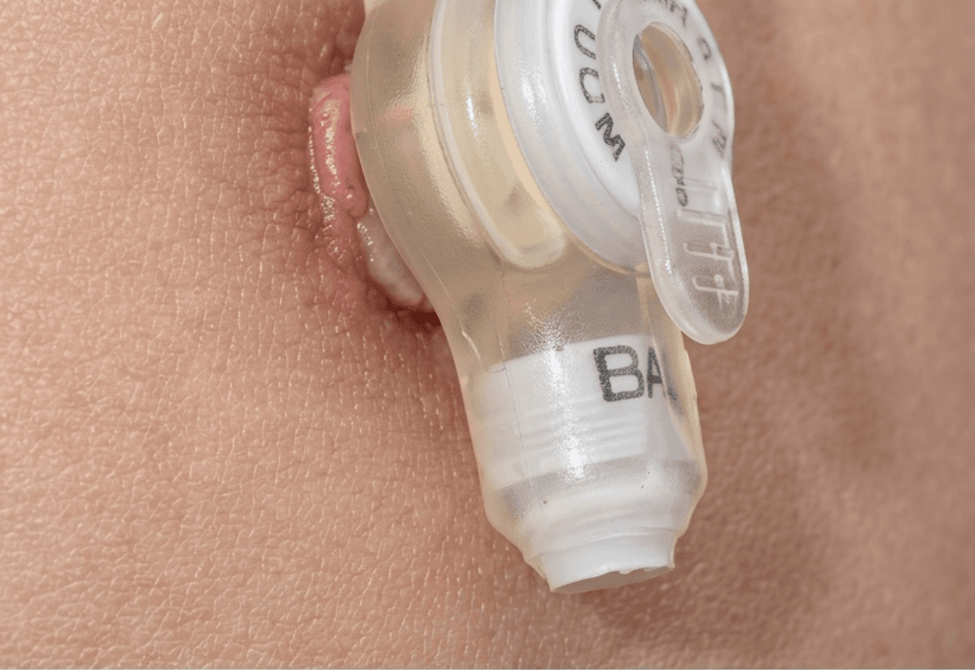 Depois de tratamento de cicatriz com laser