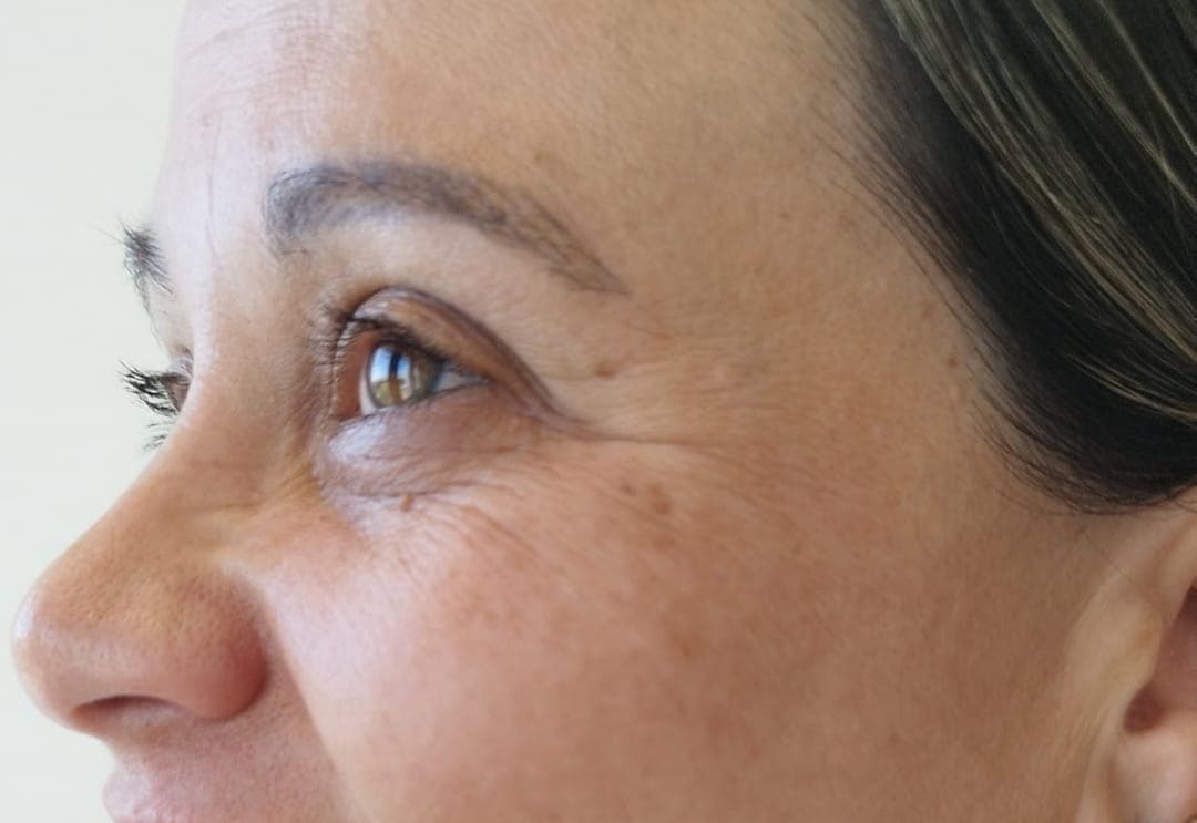 Antes do procedimento de preenchimento labial