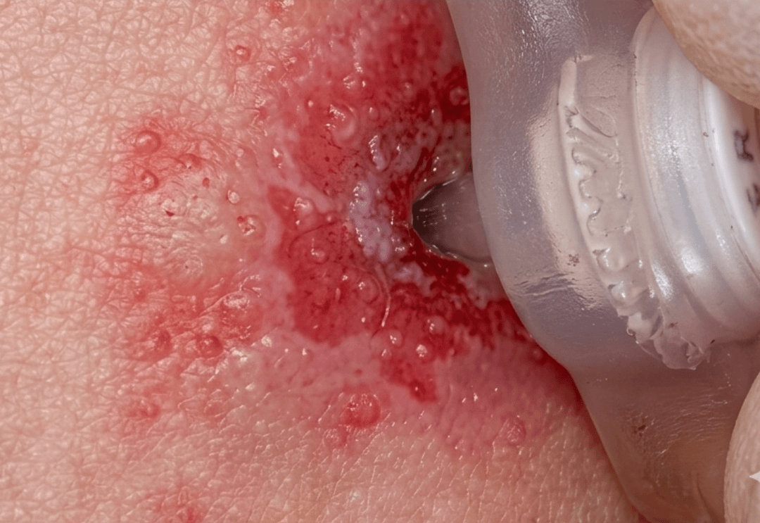 Antes de tratamento de cicatriz com laser